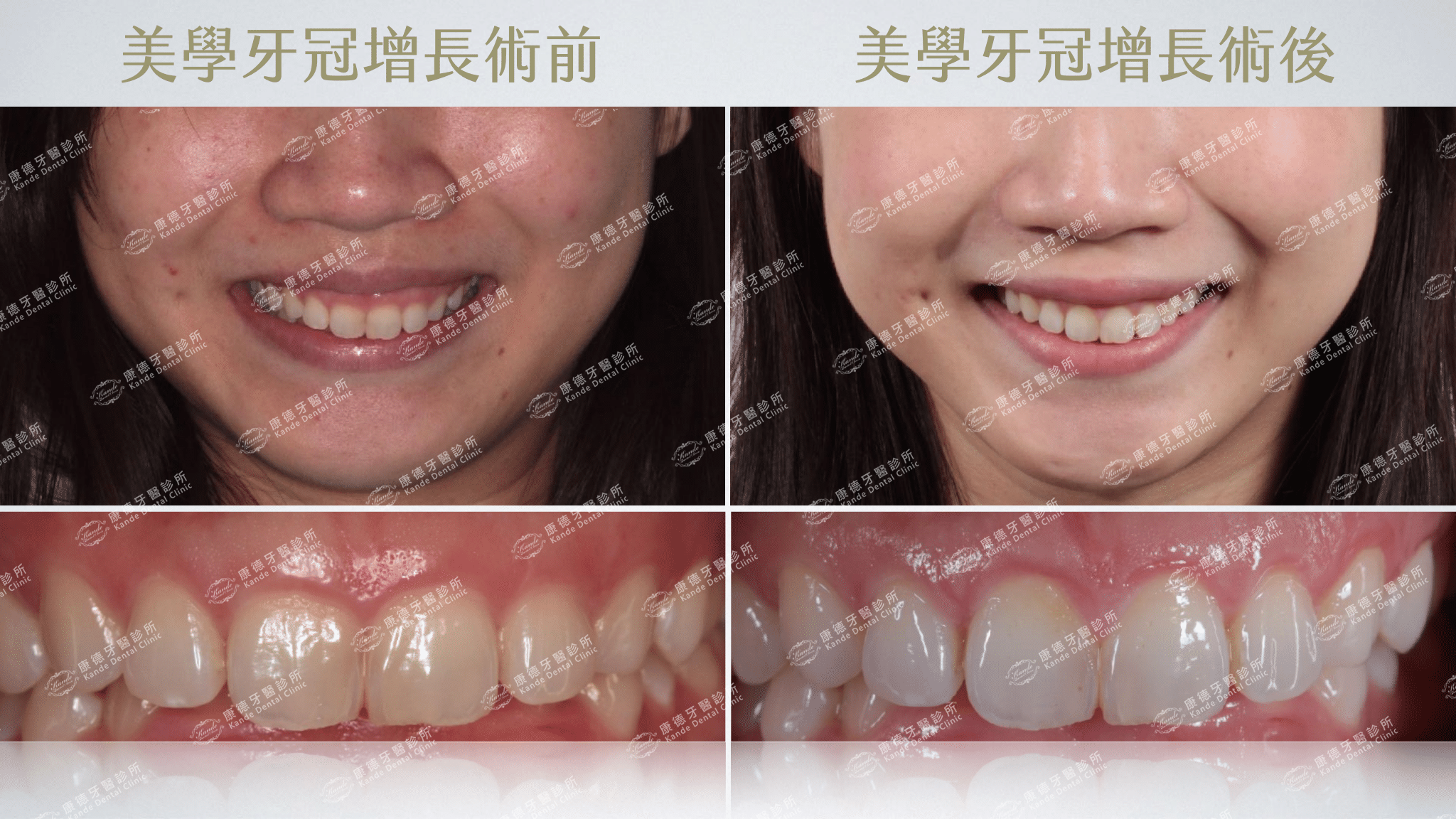 美學牙冠增長
